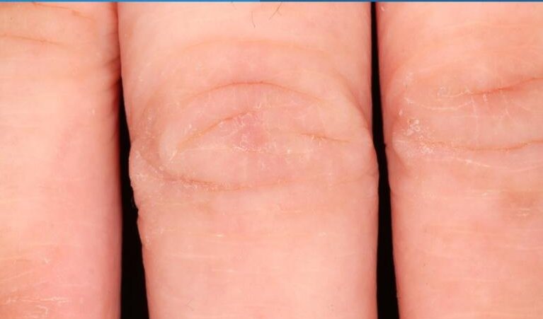 Eczema dryness at week 2