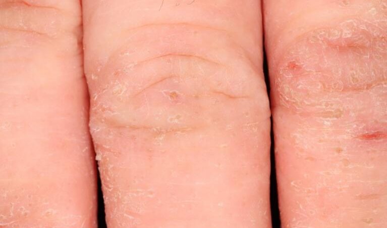 Eczema dryness at baseline